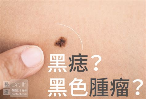 痣突出來|不大驚小怪！如何辨別「黑痣」與「黑色腫瘤」？ 